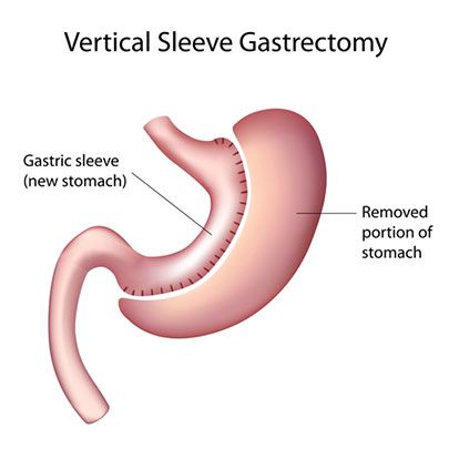 An Overview of Bariatric Procedures